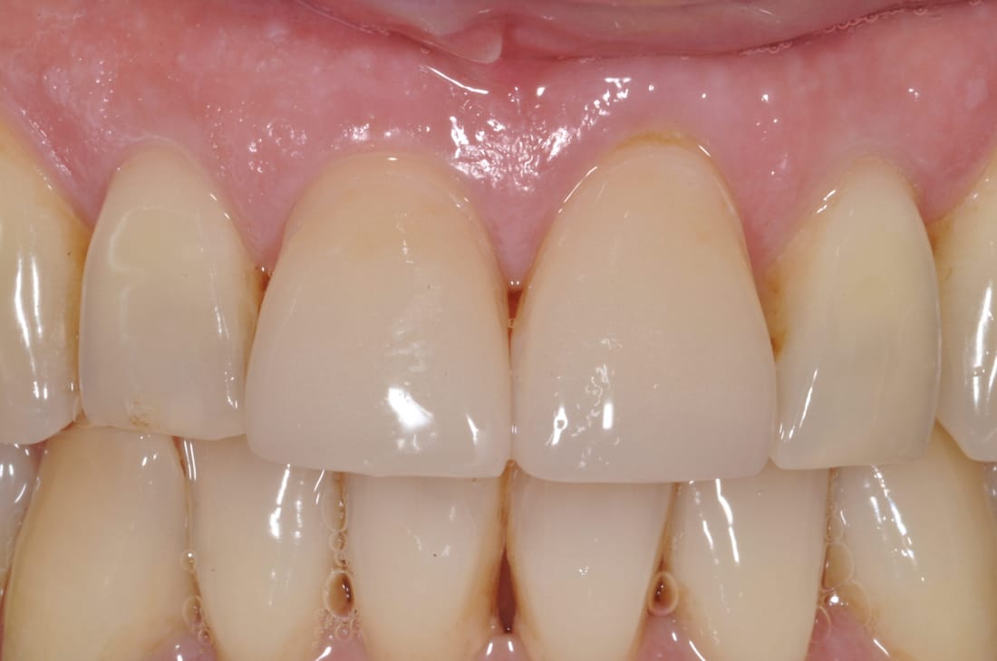 Loreta: dopo la ricostruzione con faccette in ceramica